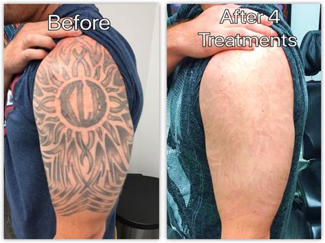 What To Expect After Laser Tattoo Removal / What to expect after laser tattoo removal treatment ...