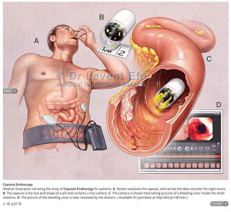 Capsule Endoscopy