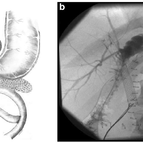 Roux-en-Y hepaticojejunostomy (schematic) with the aberrant right... | Download Scientific Diagram