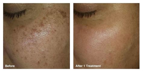 Laser Treatment For Dark Spots On Face Price