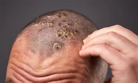 Scalp Psoriasis Pictures Symptoms And Treatment - vrogue.co
