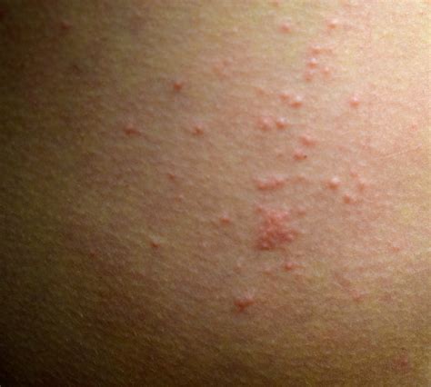 How to Deal with Scabies While Traveling — Savvy Dispatches