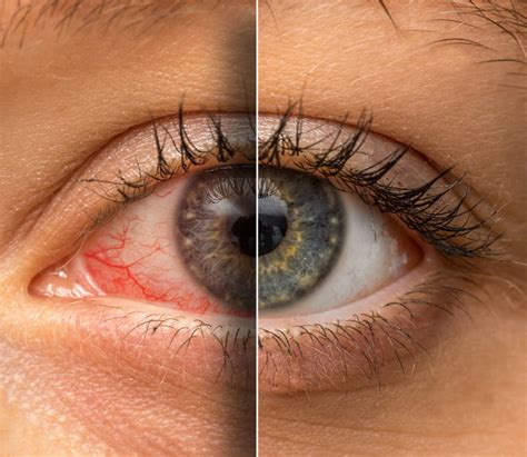 Why Are My Eyes Red & Bloodshot? | Causes and Treatment | Ocuwellness
