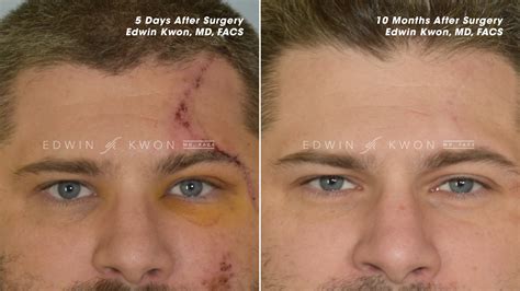 Reconstruction & Scar Revision Before & Afters - Edwin Kwon, MD, FACS