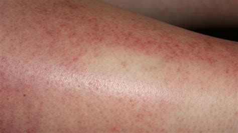 Sun Poisoning: Symptoms, Causes, Treatment, and More