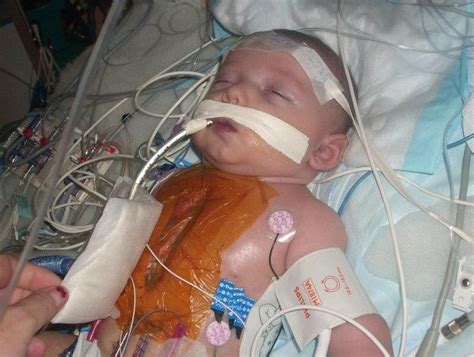 Baby L. post open heart surgery - Hypoplastic Left Heart Syndrome (HLHS ...