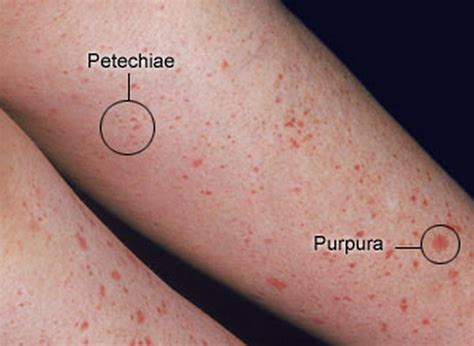 Difference between Petechiae, Purpura and Ecchymoses | Medical Laboratories