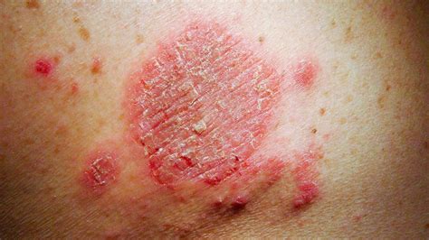 Itchy Spots On Skin Treatment | MedicineNet 2021