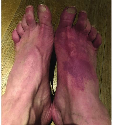 Patchy purple discoloration of the right foot during an episode of... | Download Scientific Diagram