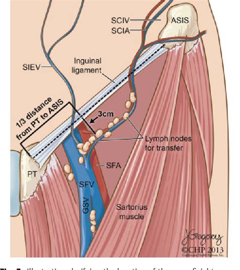 Groin lymph nodes - tewspromos