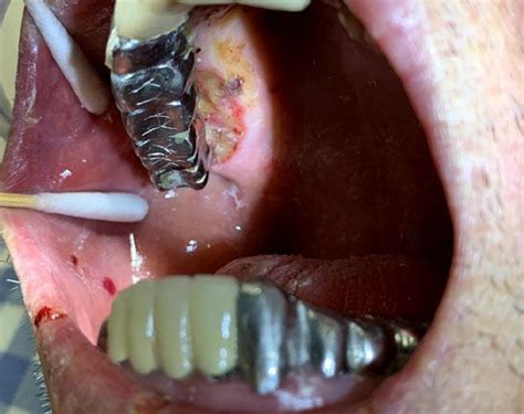 Mouth Larva or Oral Myiasis: Causes, Symptoms & Treatment