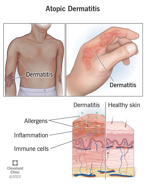 The Differences Between Rashes and Eczema (And How to Tell Which One You Have), a rash - mi-pro ...