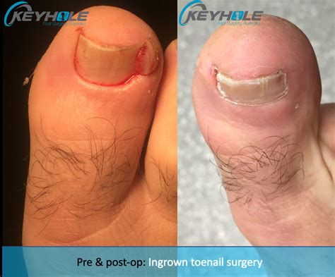 Ingrown Toenail Removal Before And After