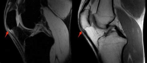 Patellar Tendon Tear | coachingultrasound