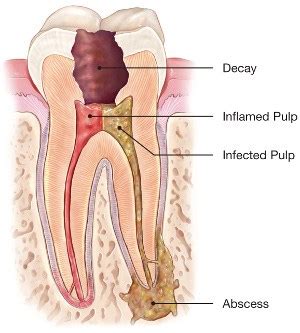 Root Canal Treatment - American Association of Endodontists