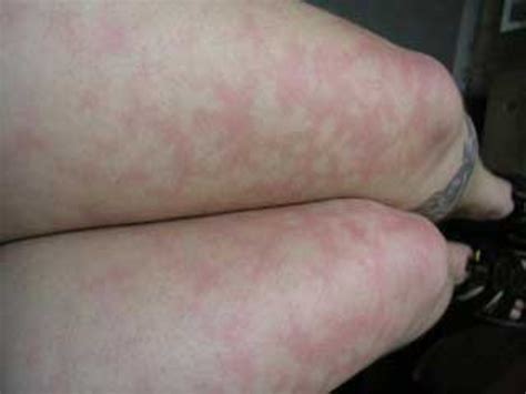 What Causes Blotchy Skin on Legs? - YouMeMindBody