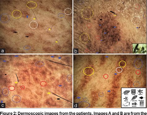 Figure 2 from Dermoscopy of Macular Amyloidosis | Semantic Scholar