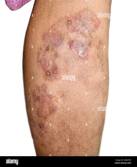 Fungal infection called tinea corporis in leg of Asian woman. Widespread ringworm over lower ...