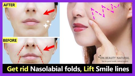 Get rid Smile Wrinkles, Laugh lines, Nasolabial folds, Lift Smile lines ...