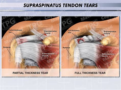 Icd 10 Code For Partial Tendon Tear Supraspinatus