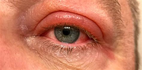Eyelid Infection