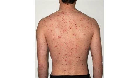 Rash on Back: Causes Treatments, Symptoms, and More