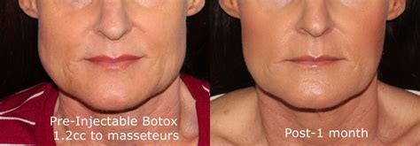 groff_botox_masseter_injections_wrinklereduction | Botox, Botox ...