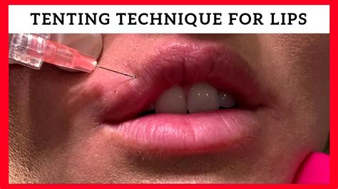 Tenting Technique for Lip Enhancement by Dr. Steven F Weiner - YouTube