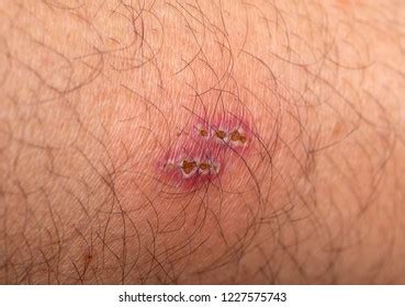 Wound Infection On Skin Skin Lesions Foto stock 1227575743 | Shutterstock