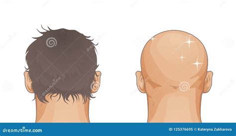 Man with Hair Loss Problem Isolated on White Background, Cartoon Style on White Stock ...