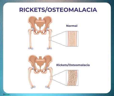 OSTEOMALACIA - Symptoms, Causes, Risk Groups, Prevention and Treatment ...