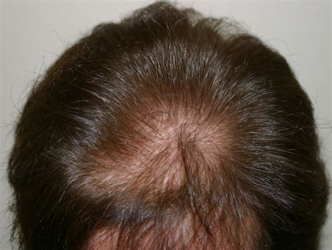 Case-7965 | Leonard Hair Transplant Associates