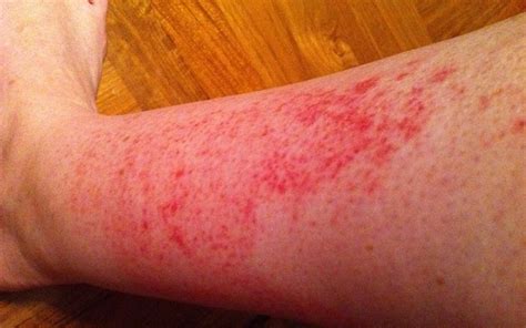 What Causes Red Blotchy Rash On Legs - Printable Templates Protal