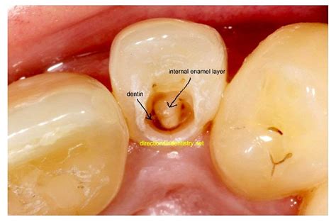 DENS IN DENTE: Maxillary Lateral Incisor - Ovi Dental