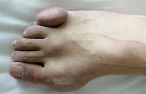 Surgical removal of tophi, the treatment process of one of my gout patients - iMedia