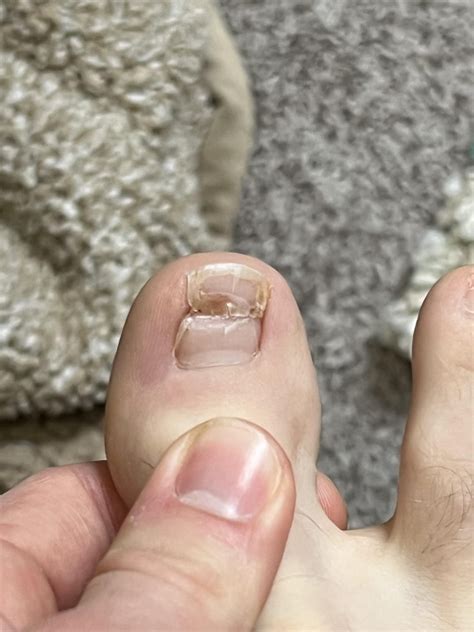 cotton under ingrown toenail : r/Ingrown_Toenails