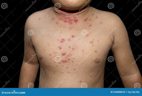 molluscum contagiosum skin lesions also called water warts Coloso