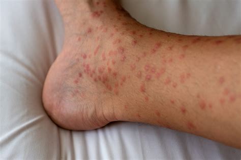 Papular Urticaria: A Guide to This Severe Bug Bite Reaction | The Healthy