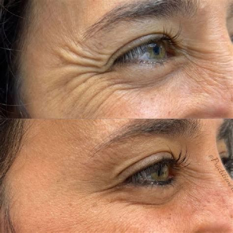 Crows Feet Wrinkles Treatment - Shay Novi Aesthetics & Wellness