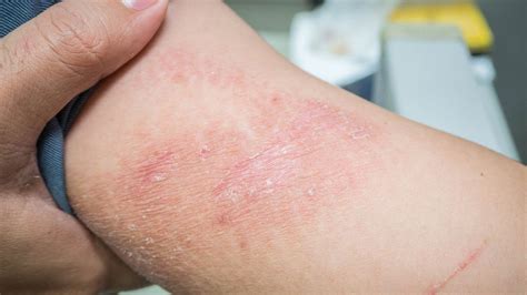 Details 102+ contact dermatitis nails best - ceg.edu.vn