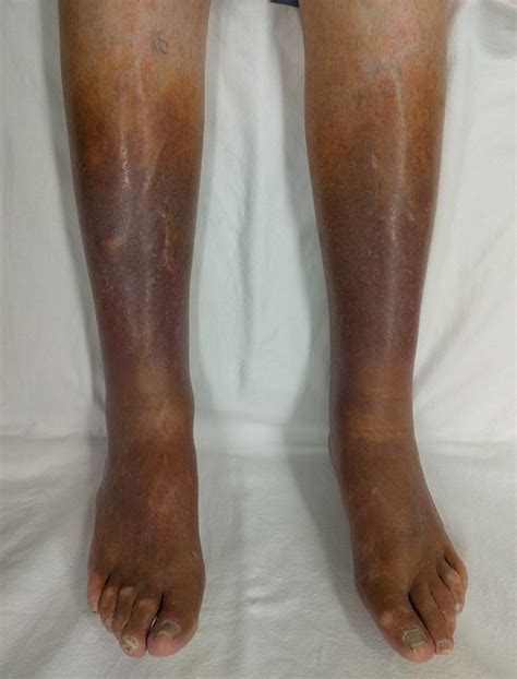 Understanding Venous Insufficiency: Causes and Symptoms