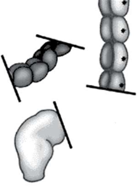 File:Megacolon surgery 02.jpg - Embryology