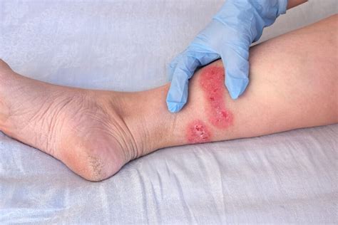 How To Heal Recurring Diabetic Sores On Legs With Amniotic Allografts