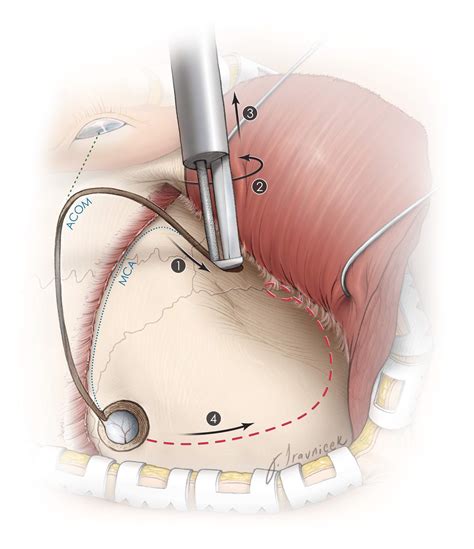 Burr Holes and Bone Flaps | The Neurosurgical Atlas