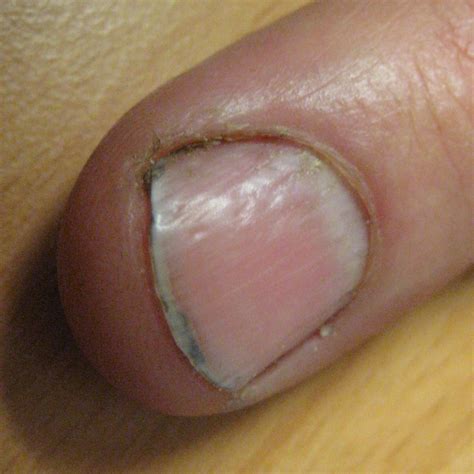 List 105+ Wallpaper Pictures Of Psoriatic Arthritis Nails Full HD, 2k, 4k