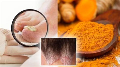 Home Remedies For Fungal Infections in Urdu - Remedy, Benefits, Gharelo Tips & Totkay