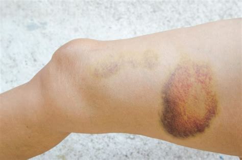 HEMATOMA – Dermatology Conditions and Treatments