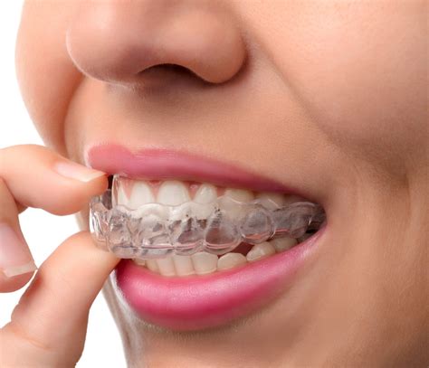 Orthodontic Treatment – Braces – Invisalign – Dental Smile Centre