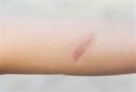 Minor Burns: Causes and Medical Treatment - eMediHealth