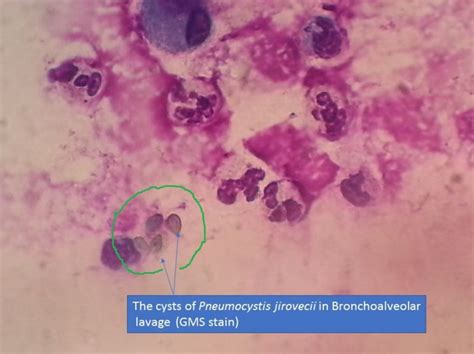 Pneumocystis jirovecii cysts in Bronchoalveolar lavage (BAL) and Its Detail